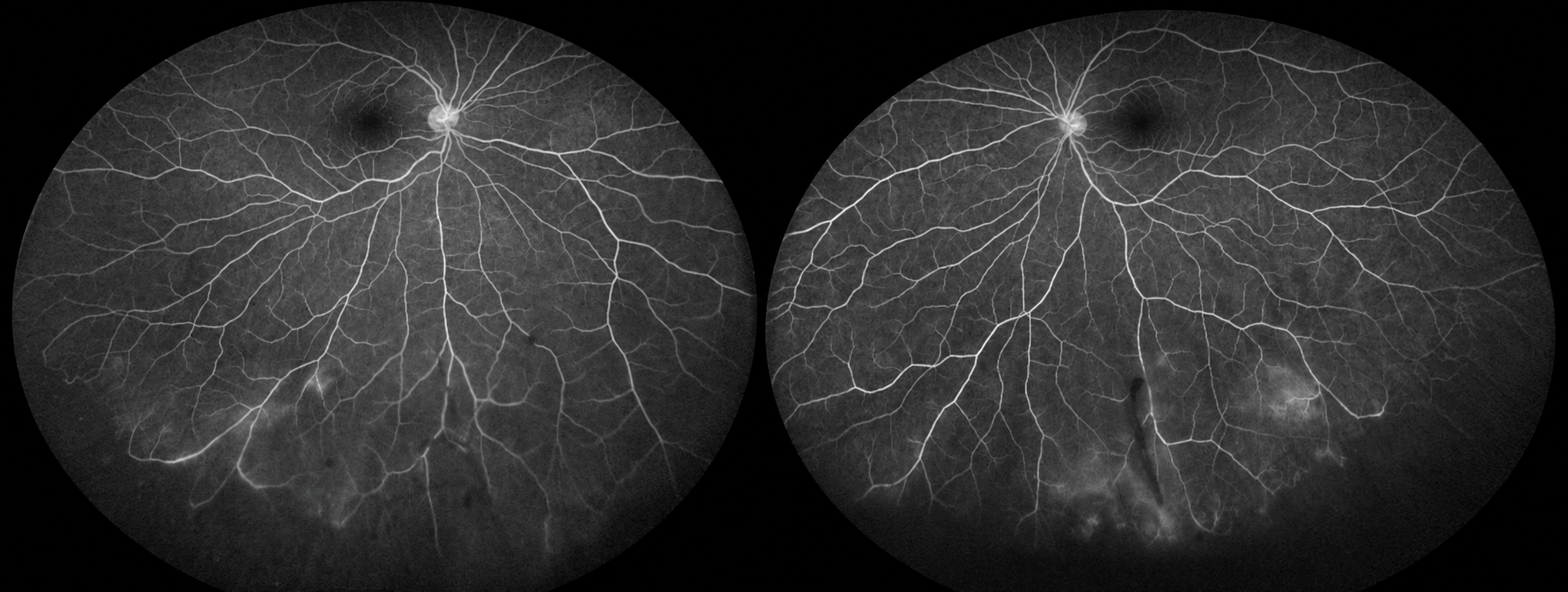 Angiografía con fluoresceína de campo ultra-amplio en un paciente con pars planitis