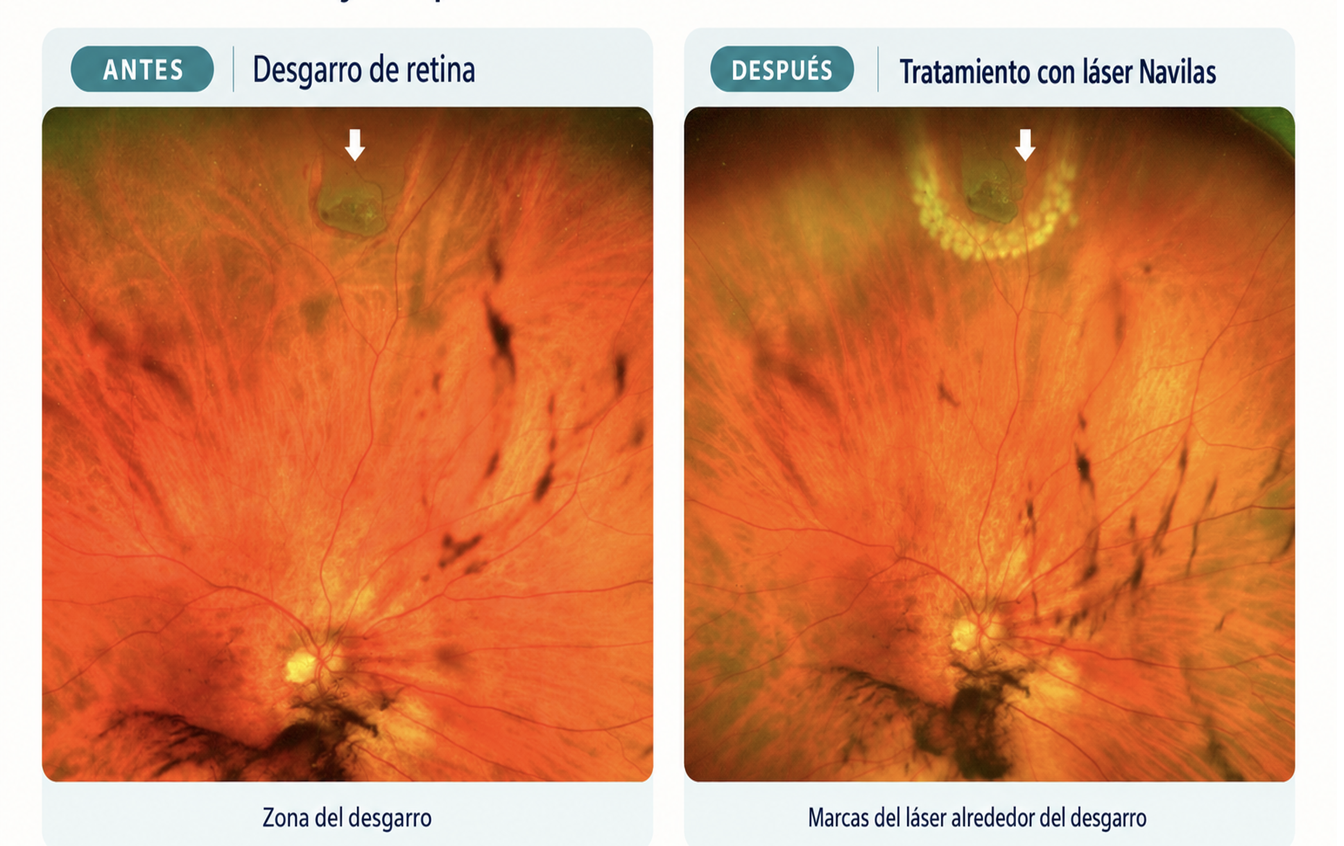 Desgarro de retina antes y despu&eacute;s del tratamiento con l&aacute;ser Navilas